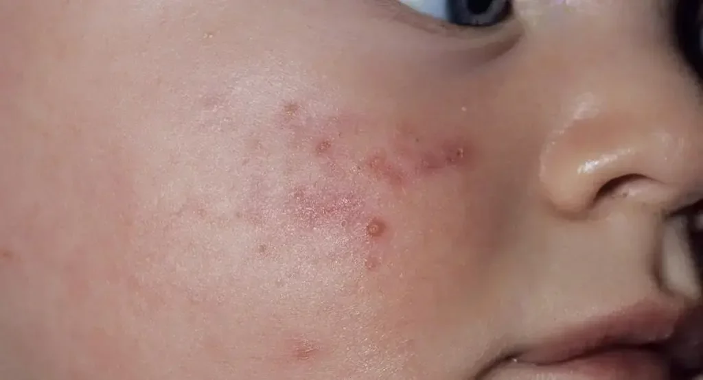 Baby Acne Treatment