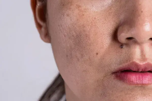 Will Hyperpigmentation from Waxing go Away?