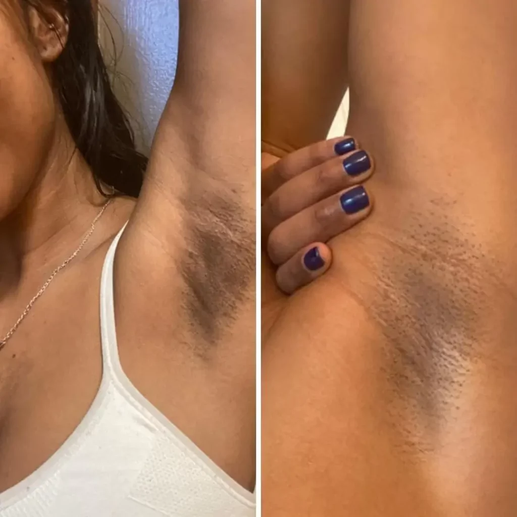 Will Hyperpigmentation from Waxing go Away?