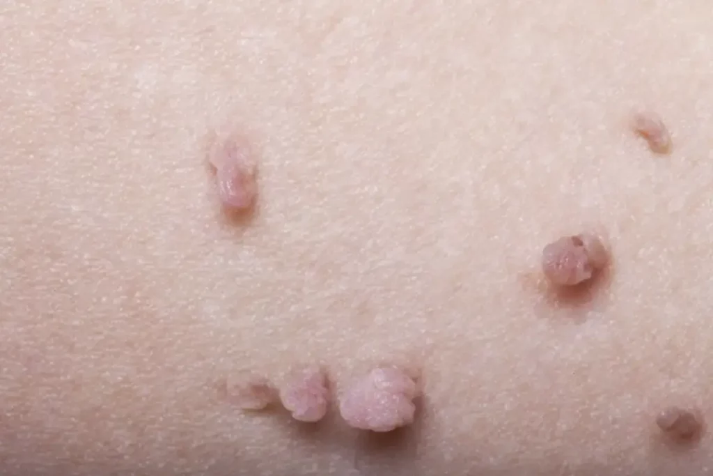 Can Skin Tags be Removed by Laser
