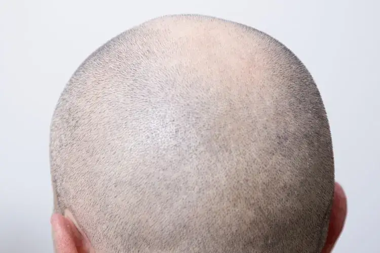 How to Get Even Skin Tone on Bald Head