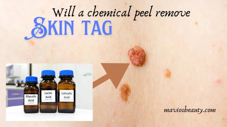 Will a Chemical Peel Remove Skin Tags